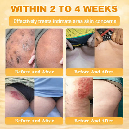 🇦🇺【70% OFF Wraps Up Today】Pureluxo® 🐄Tallow Bee Venom Healing Balm（Sorts Out Spots, Wrinkles & Knackered Skin — Steroid-Free）