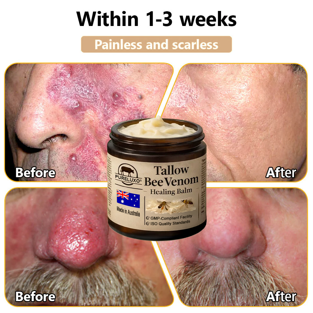 🇦🇺【70% OFF Wraps Up Today】Pureluxo® 🐄Tallow Bee Venom Healing Balm（Sorts Out Spots, Wrinkles & Knackered Skin — Steroid-Free）