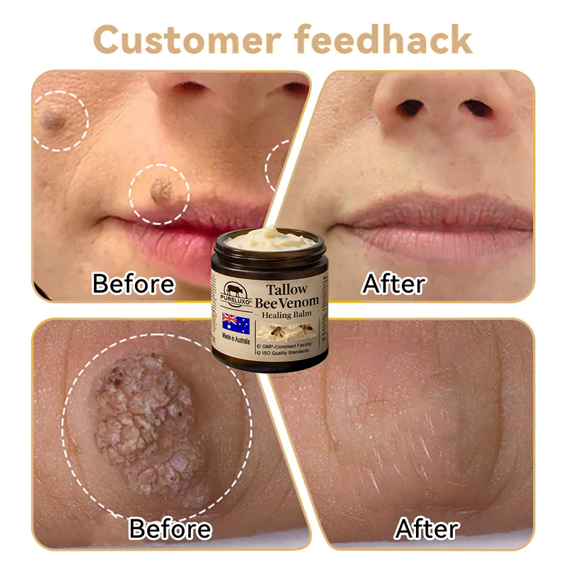 🇦🇺【70% OFF Wraps Up Today】Pureluxo® 🐄Tallow Bee Venom Healing Balm（Sorts Out Spots, Wrinkles & Knackered Skin — Steroid-Free）