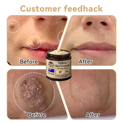 🇦🇺【70% OFF Wraps Up Today】Pureluxo® 🐄Tallow Bee Venom Healing Balm（Sorts Out Spots, Wrinkles & Knackered Skin — Steroid-Free）