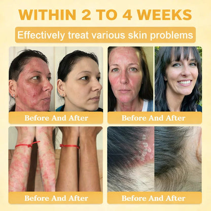 🇦🇺【70% OFF Wraps Up Today】Pureluxo® 🐄Tallow Bee Venom Healing Balm（Sorts Out Spots, Wrinkles & Knackered Skin — Steroid-Free）